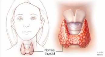 Thyroid Symptoms, Causes, Easy Home Medications